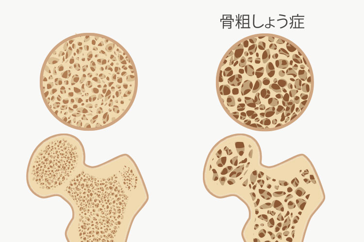 骨粗しょう症イメージ